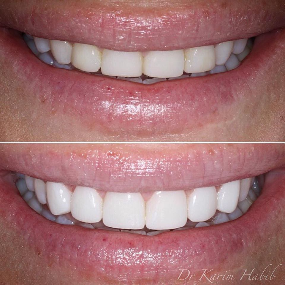 Composite Veneers Sydney | Dental Bonding Sydney - Dentist Ryde ...