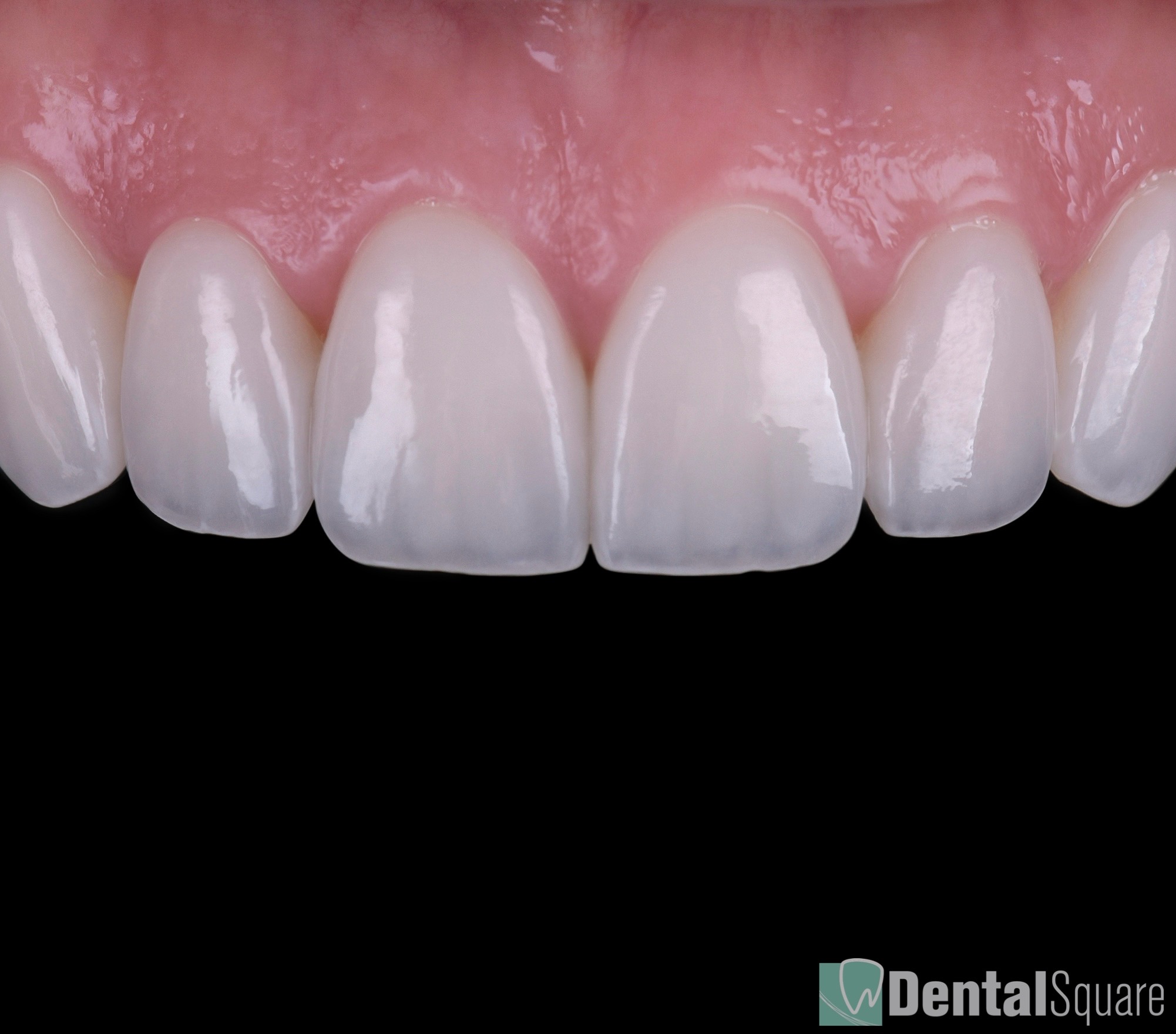 Australia's trusted provider of the most natural porcelain veneers