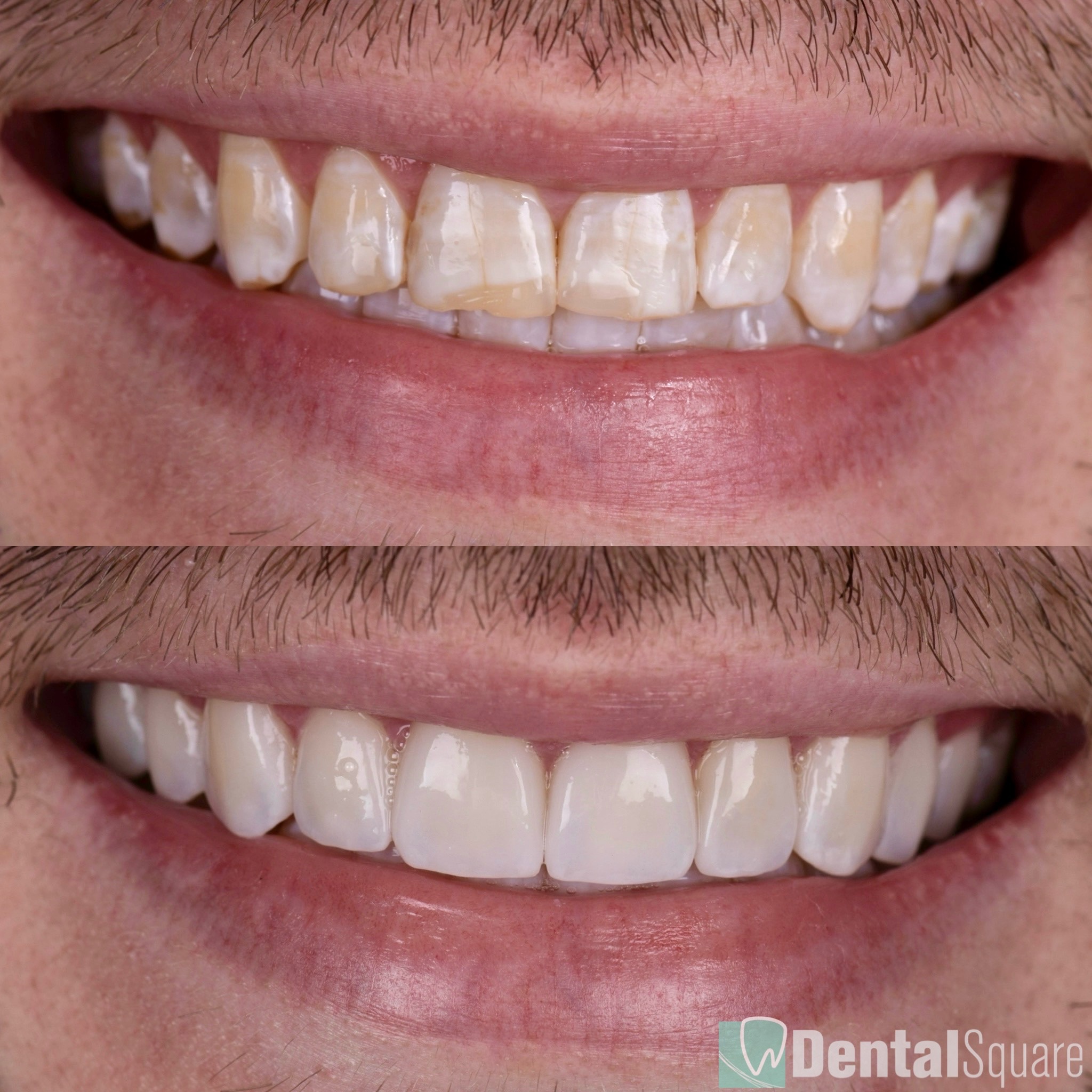 Stained Teeth treated with Porcelain Veneers