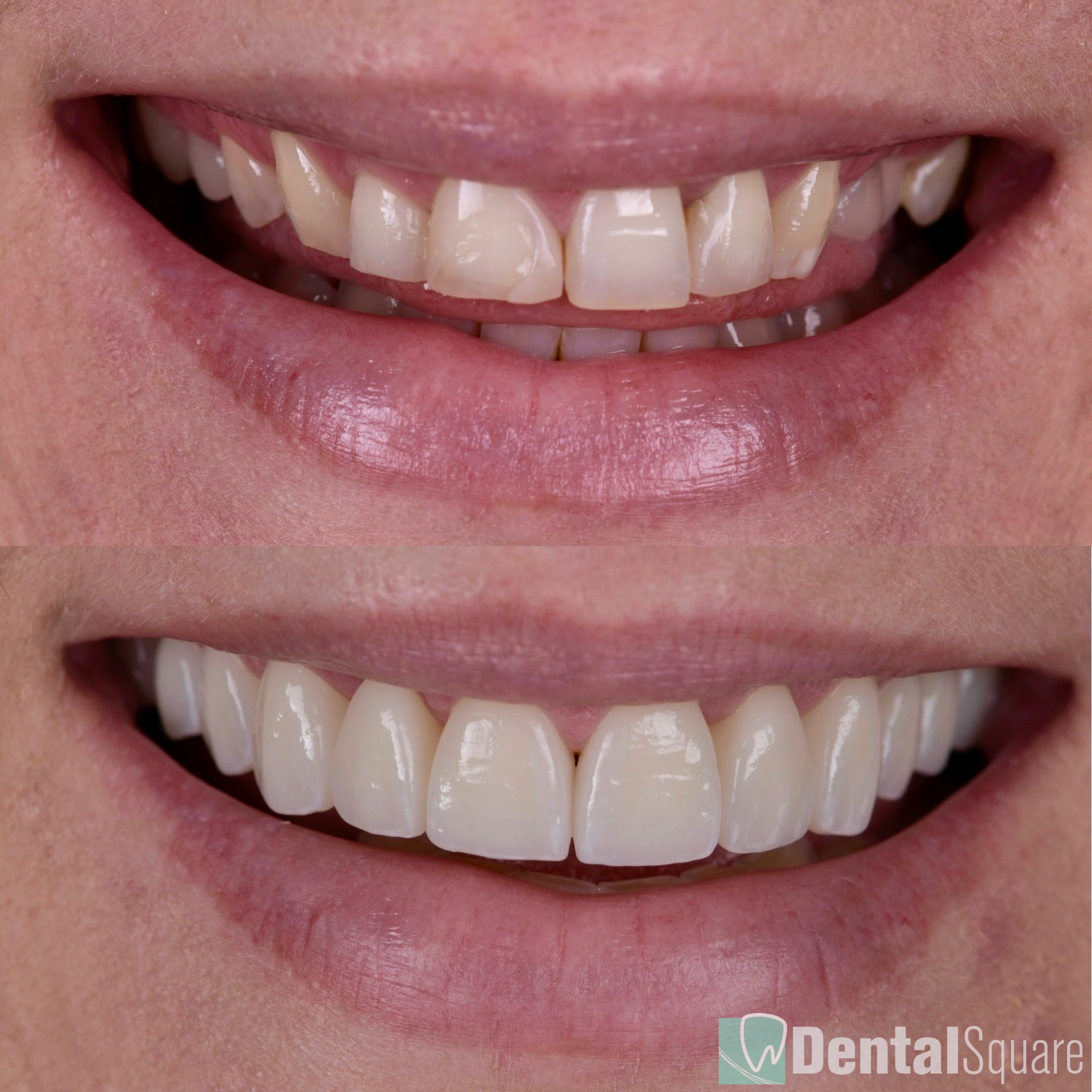 Full Mouth Rehab with Porcelain Veneers and crowns in Sydney