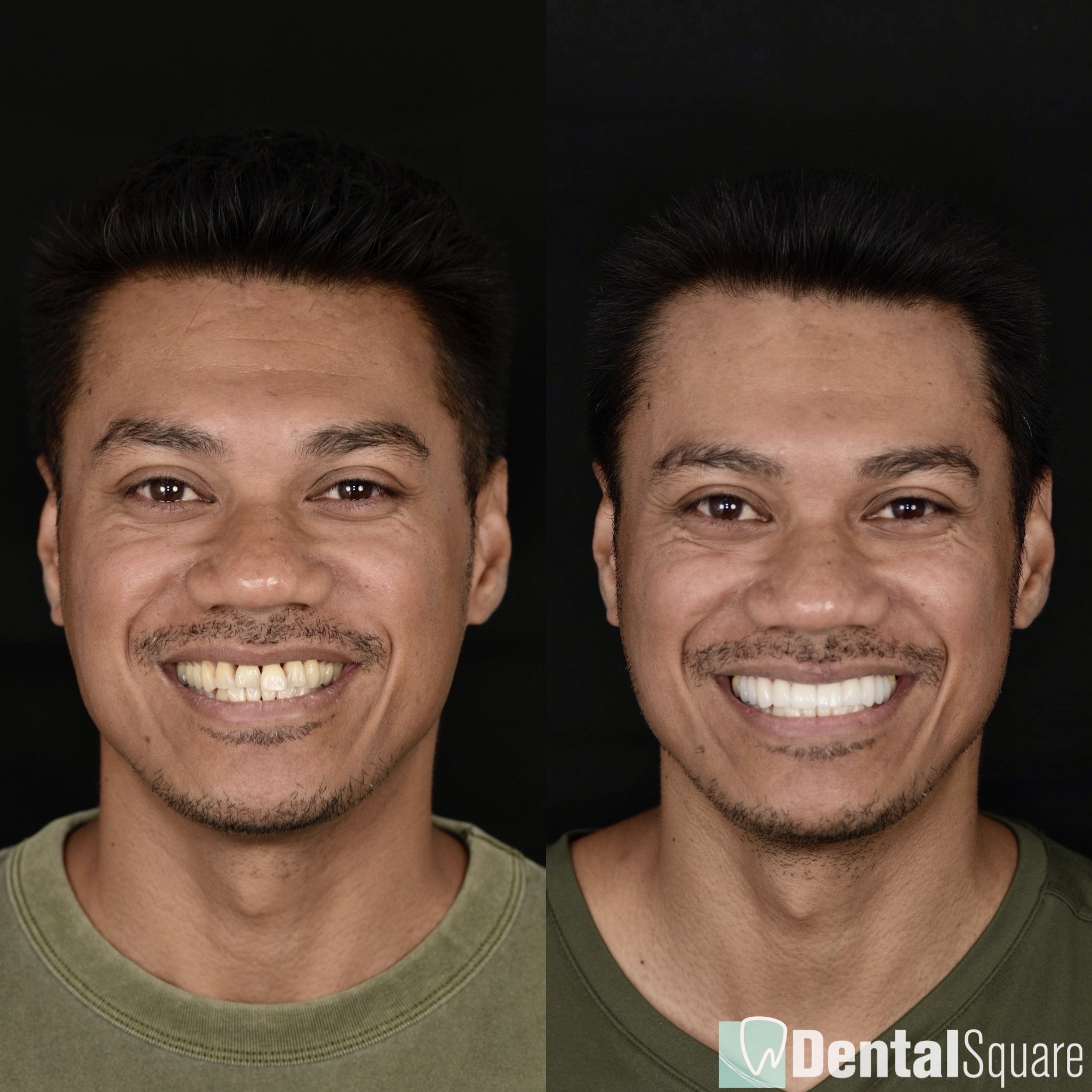 A New Smile Tailored to you - Sydney Porcelain Veneers