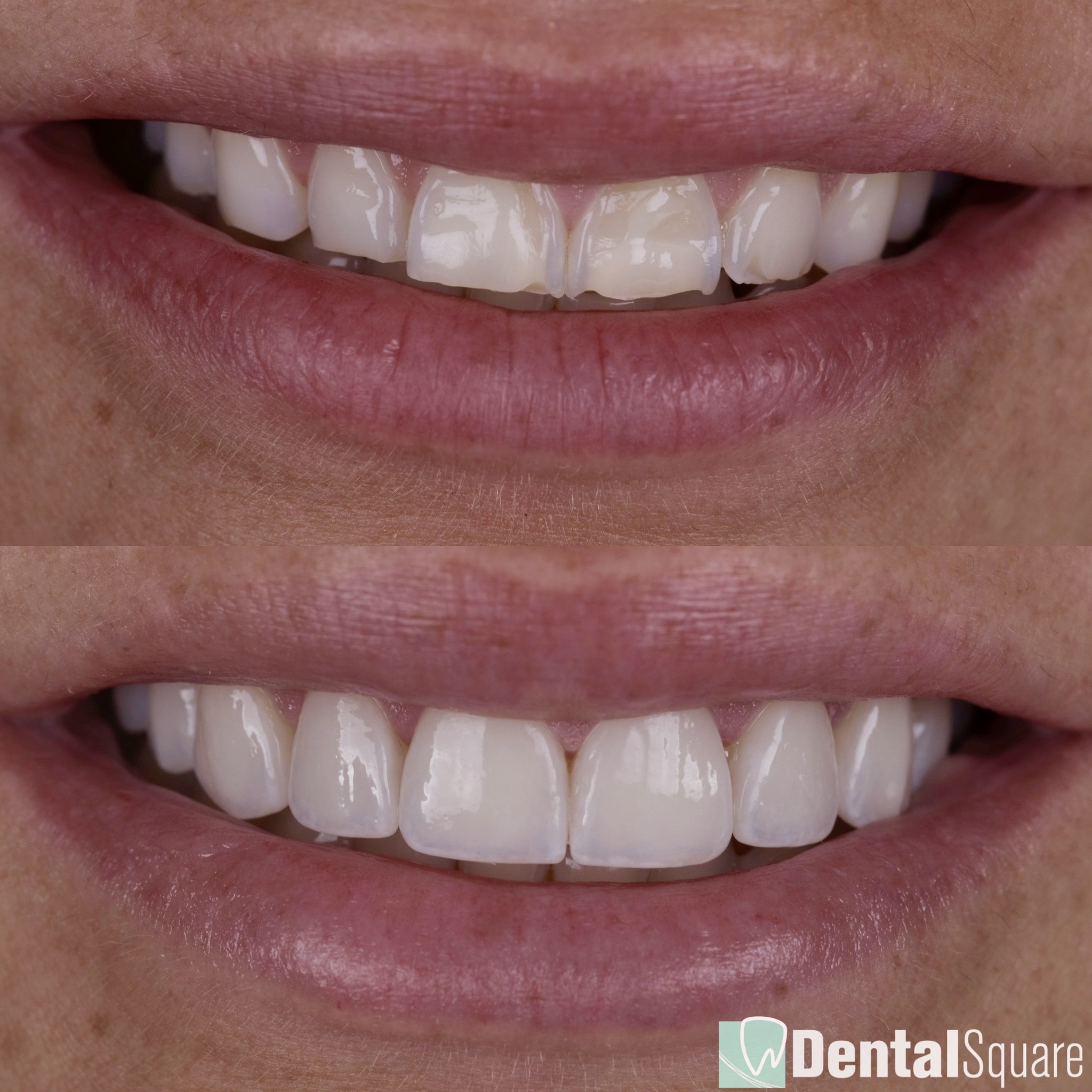 Treatment of severe wear and erosion with Veneers