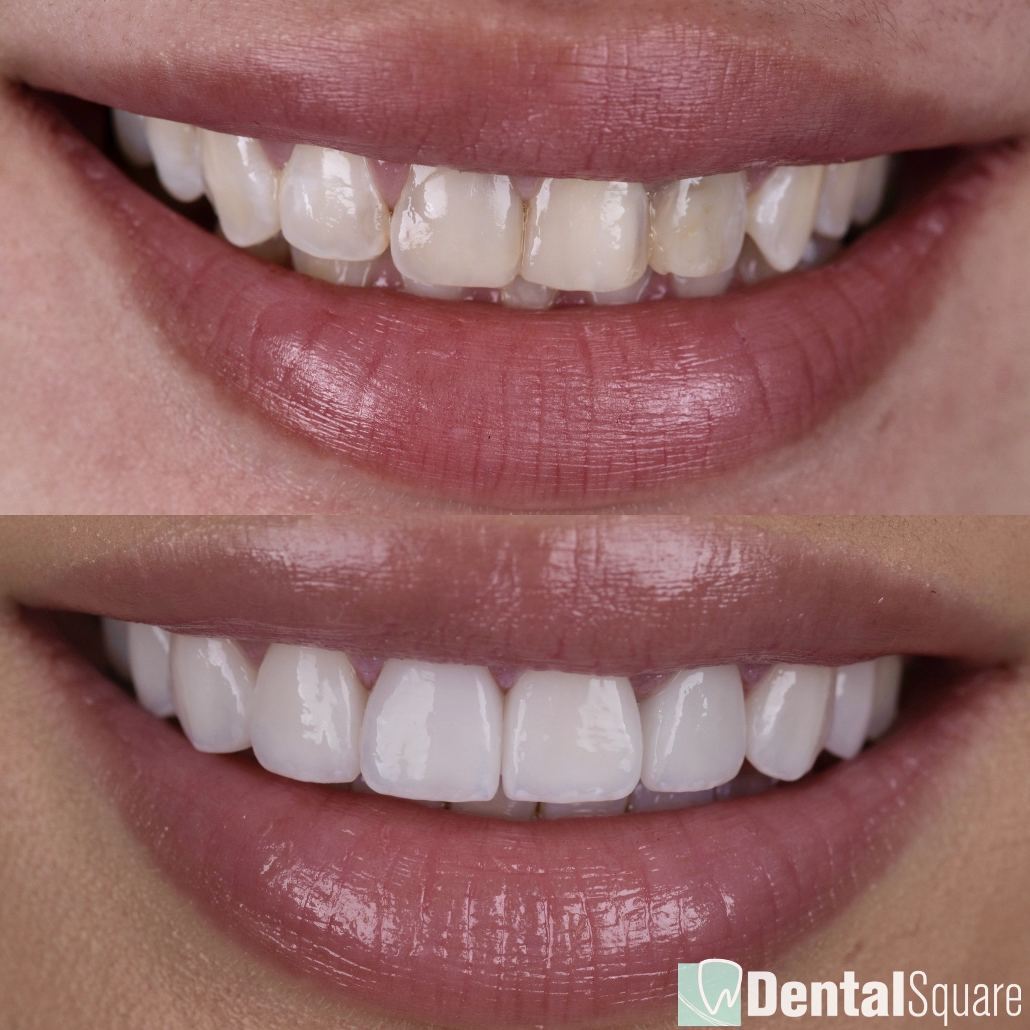 Treatment of stains and cavities with healthy looking veneers