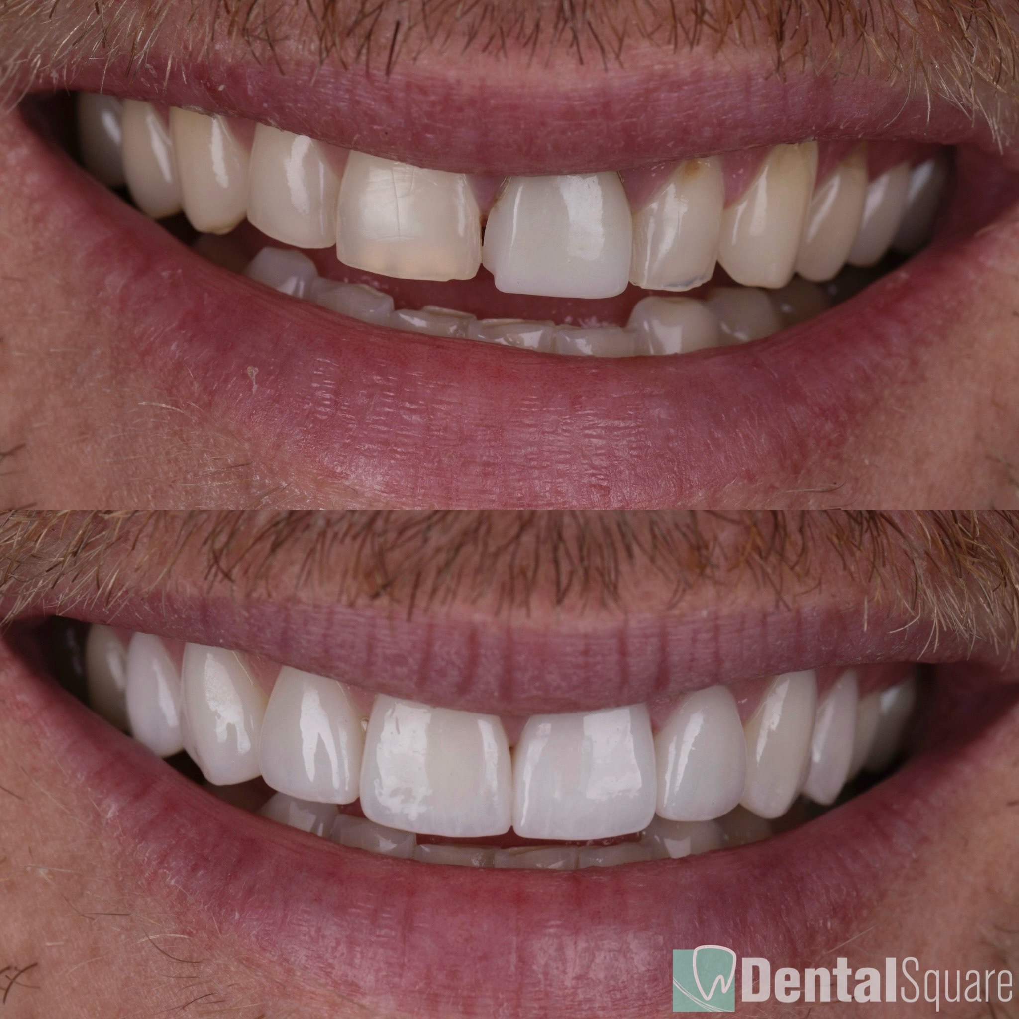 Experts in the ultra-natural look veneers