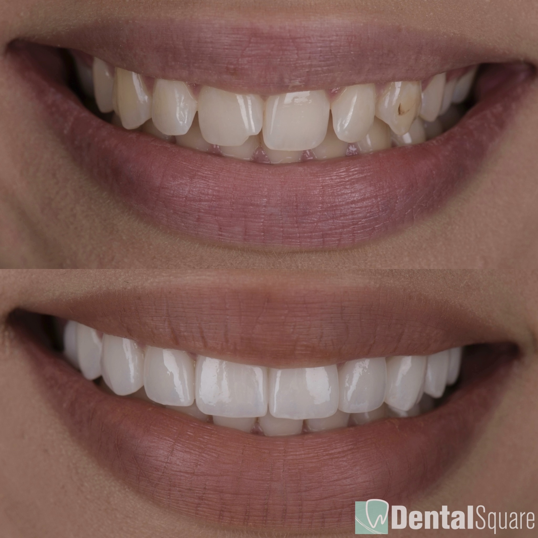 Utra Natural and Glamorous Porcelain Veneers in Sydney