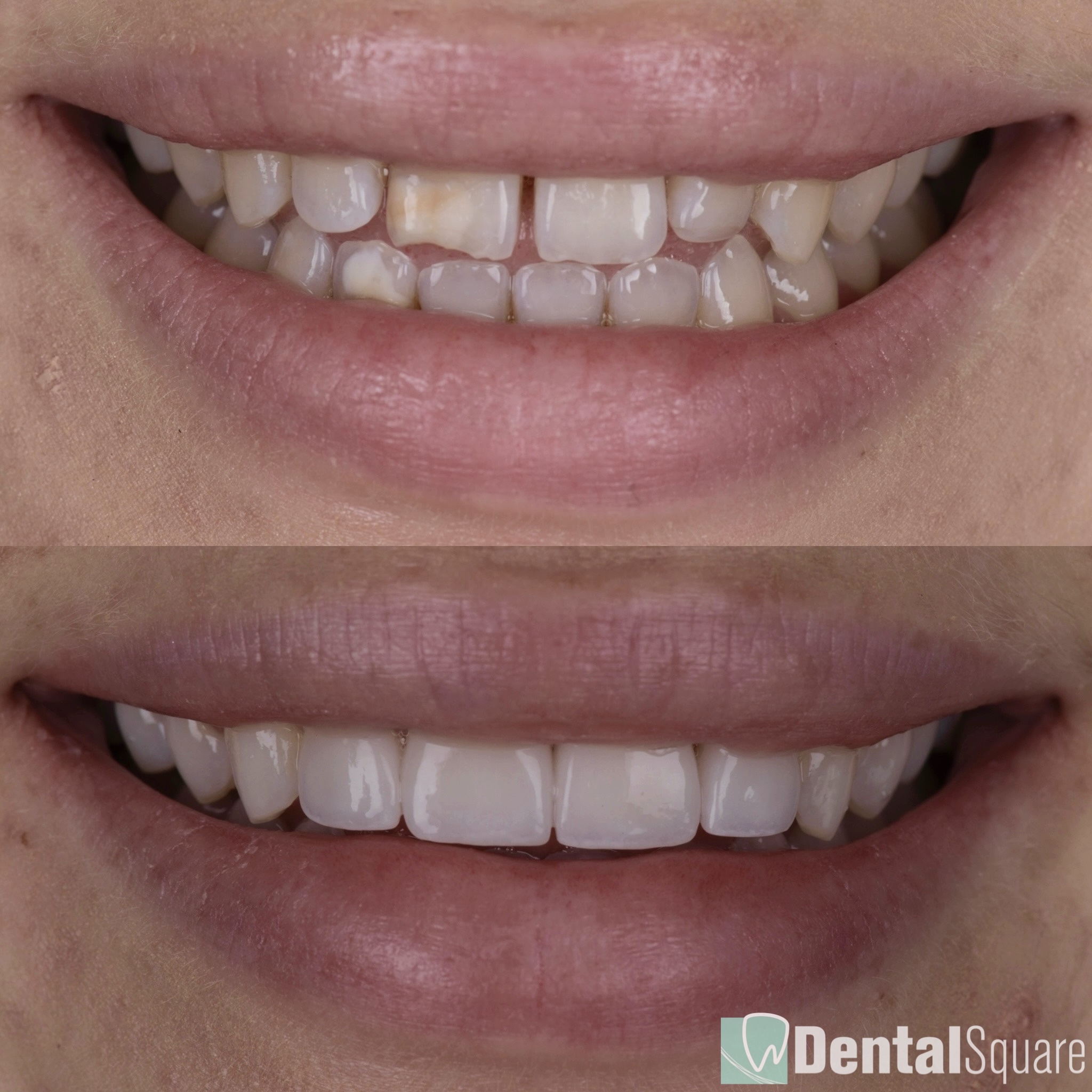 Porcelain Veneers Sydney Transformation