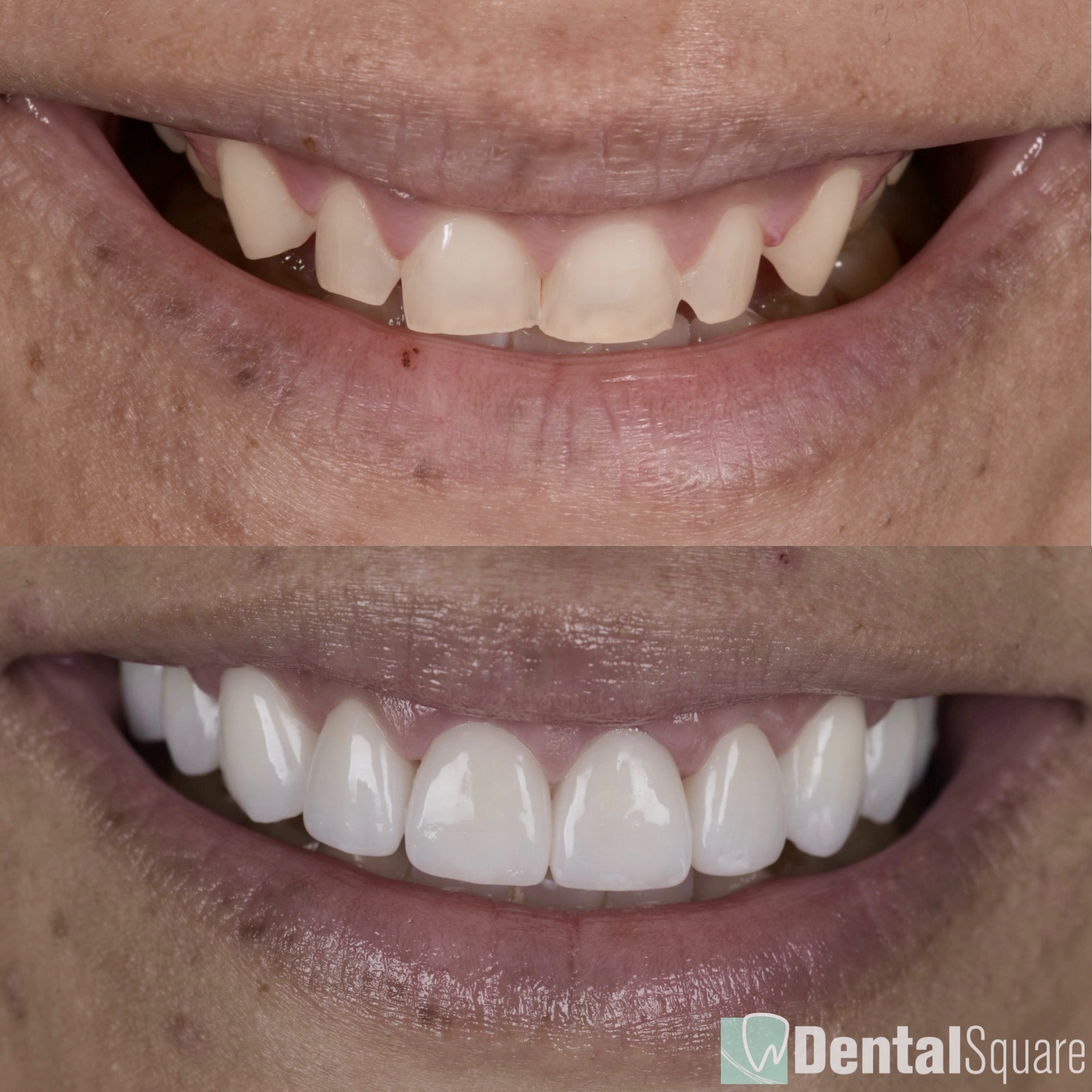 Gum contouring and Porcelain Veneers Sydney