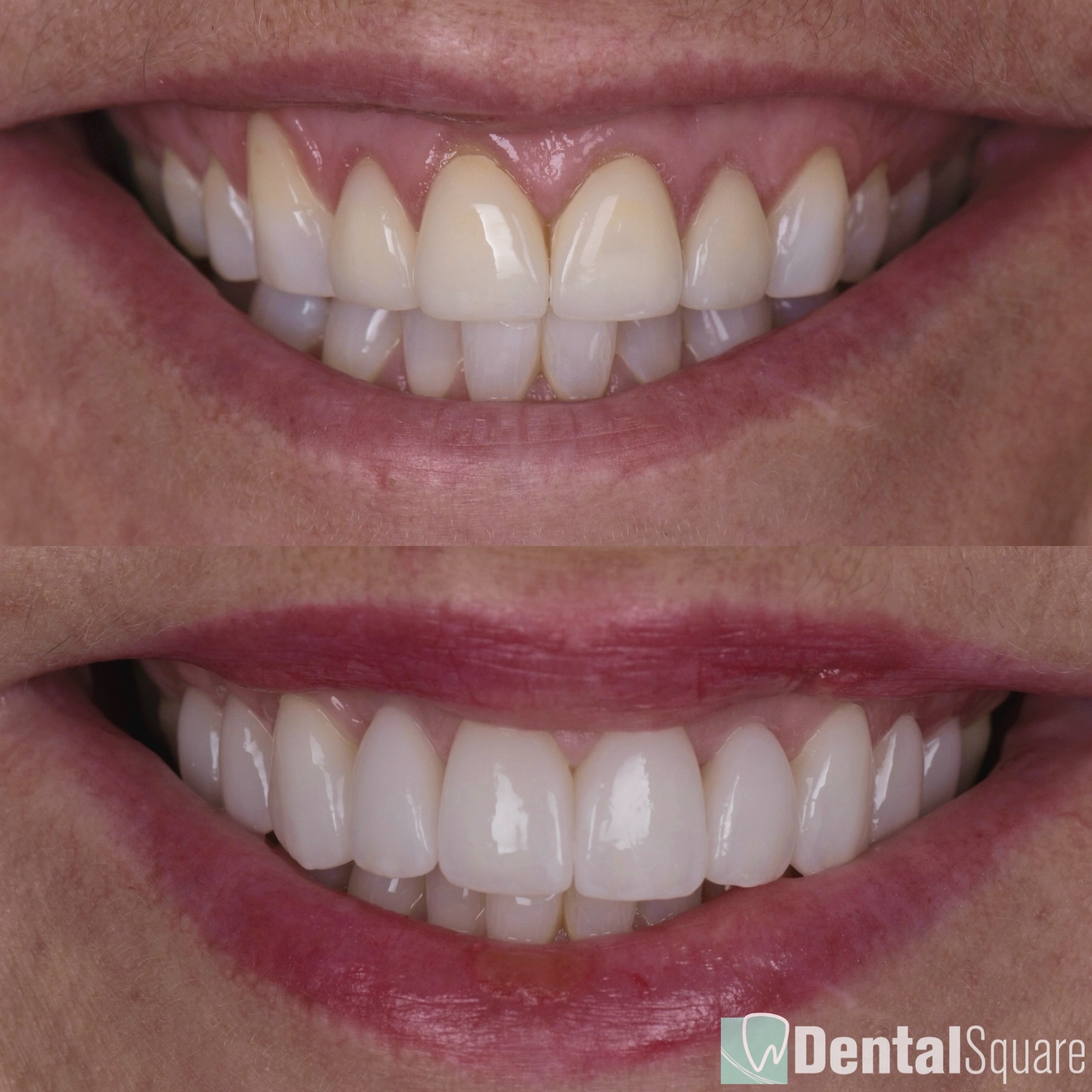 Porcelain Veneers and Gum treatment