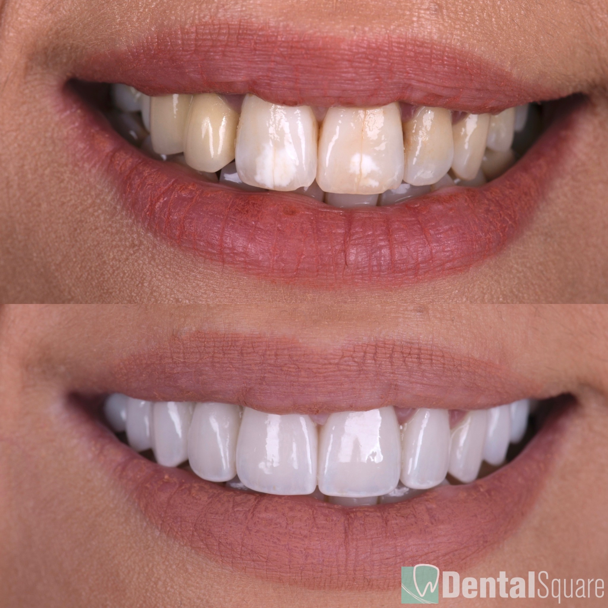 Prewedding Smile Makeover Dental Veneers