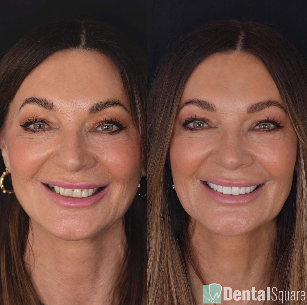 Sydney Porcelain Veneers Specialist